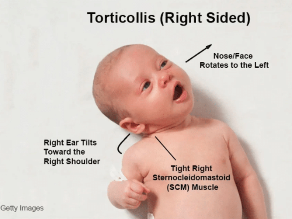 torticollis